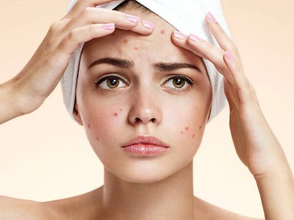  Với những làn da đang bị mụn, việc dùng sữa rửa mặt giúp da sạch hơn, từ đó giảm khả năng bị viêm, nhiễm trùng da